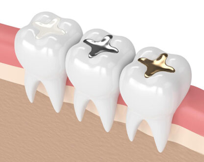 How Dental Fillings Prevent Cavities and Restore Tooth Function?