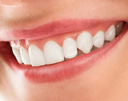 How Long Do Tooth Whitening Results Last? Factors That Affect Longevity