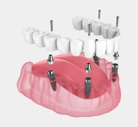 Implants-Supported Dentures